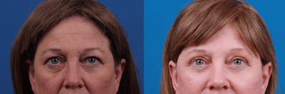 Eyelid Surgery Before & After Gallery - Patient 122592568 - Image 1