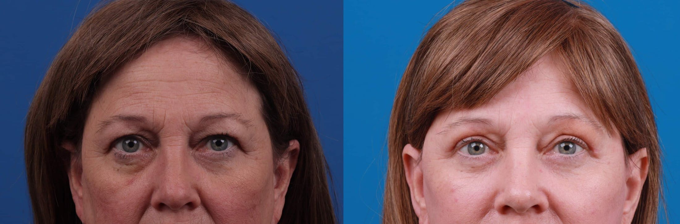 Eyelid Surgery Before & After Gallery - Patient 122592568 - Image 1
