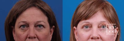 Eyelid Surgery Before & After Gallery - Patient 127787 - Image 1
