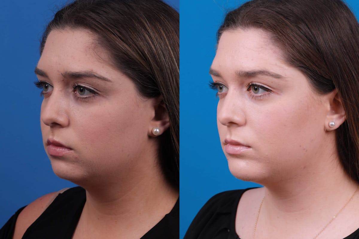 Chin Augmentation Before & After Gallery - Patient 122591906 - Image 4