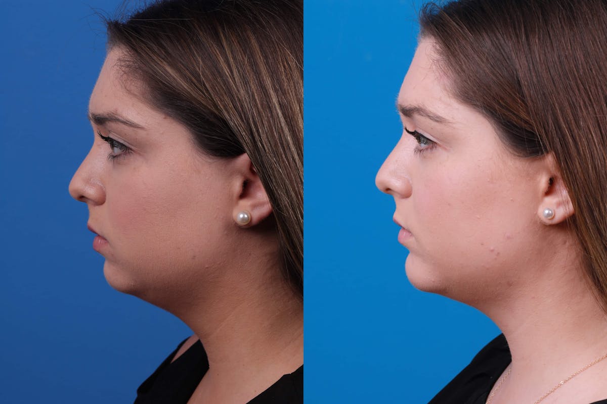 Laser Assisted Weekend Neck Lift Before & After Gallery - Patient 122593748 - Image 3