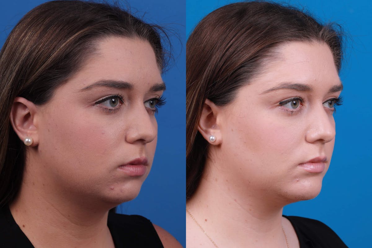 Laser Assisted Weekend Neck Lift Before & After Gallery - Patient 122593748 - Image 2