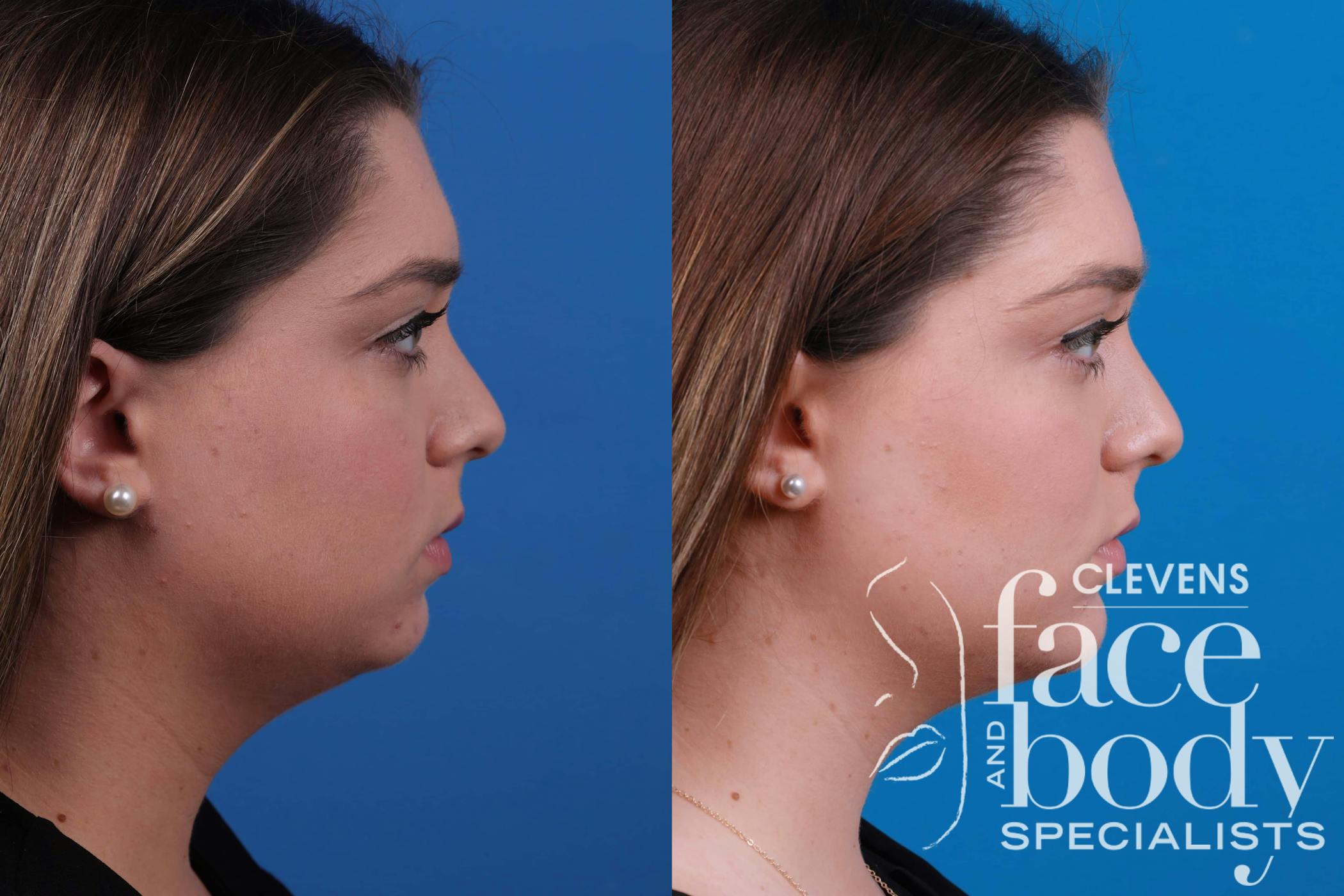 Chin Augmentation