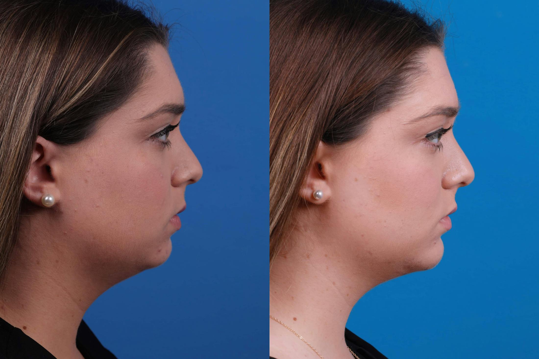 Laser Assisted Weekend Neck Lift Before & After Gallery - Patient 122593748 - Image 1