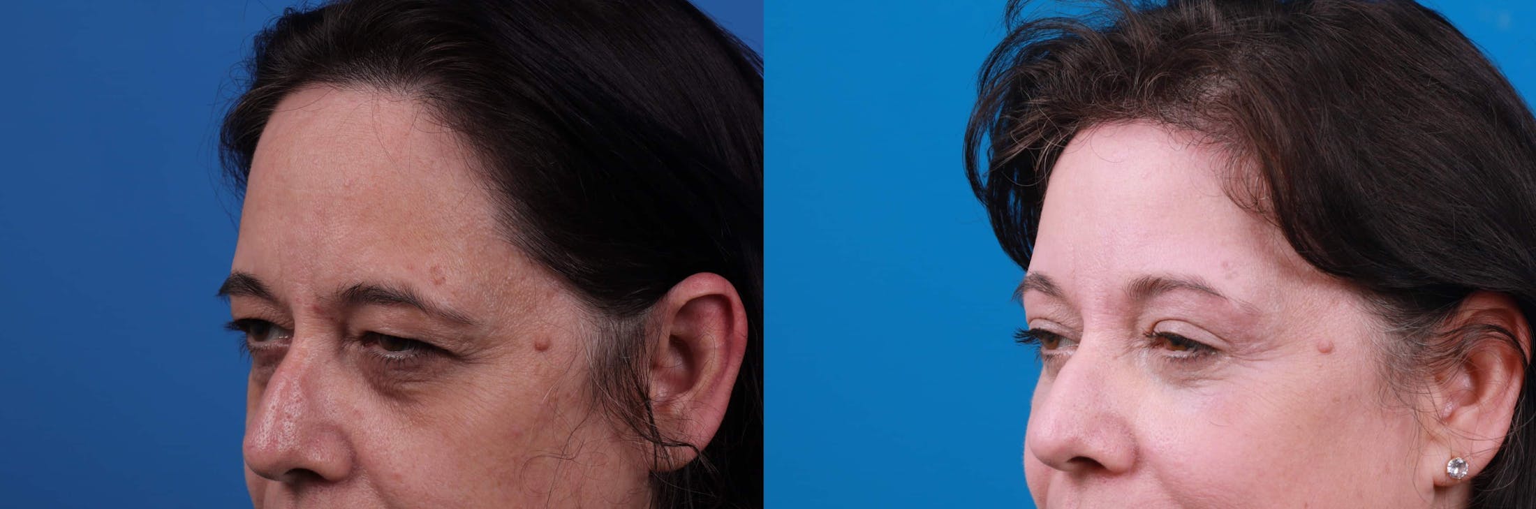 Eyelid Surgery Before & After Gallery - Patient 122592564 - Image 3