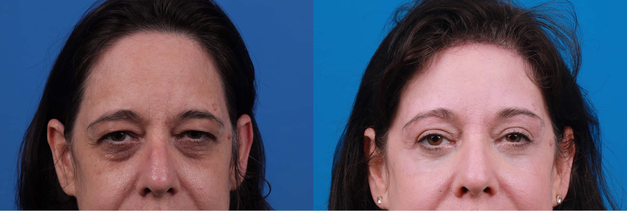 Brow Lift Before & After Gallery - Patient 122591775 - Image 1