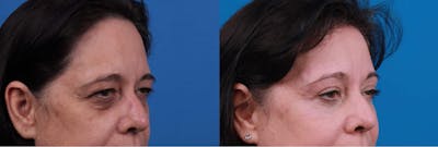 Eyelid Surgery Before & After Gallery - Patient 122592564 - Image 1