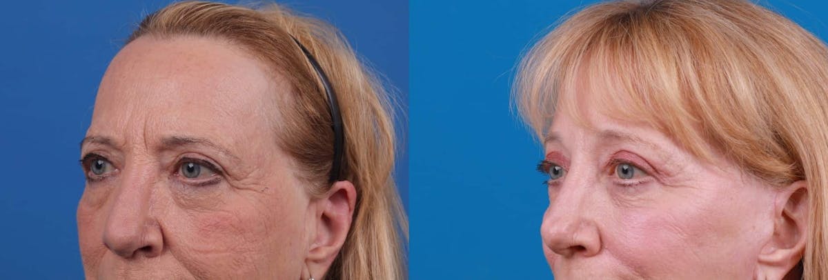 Brow Lift Before & After Gallery - Patient 122591774 - Image 2