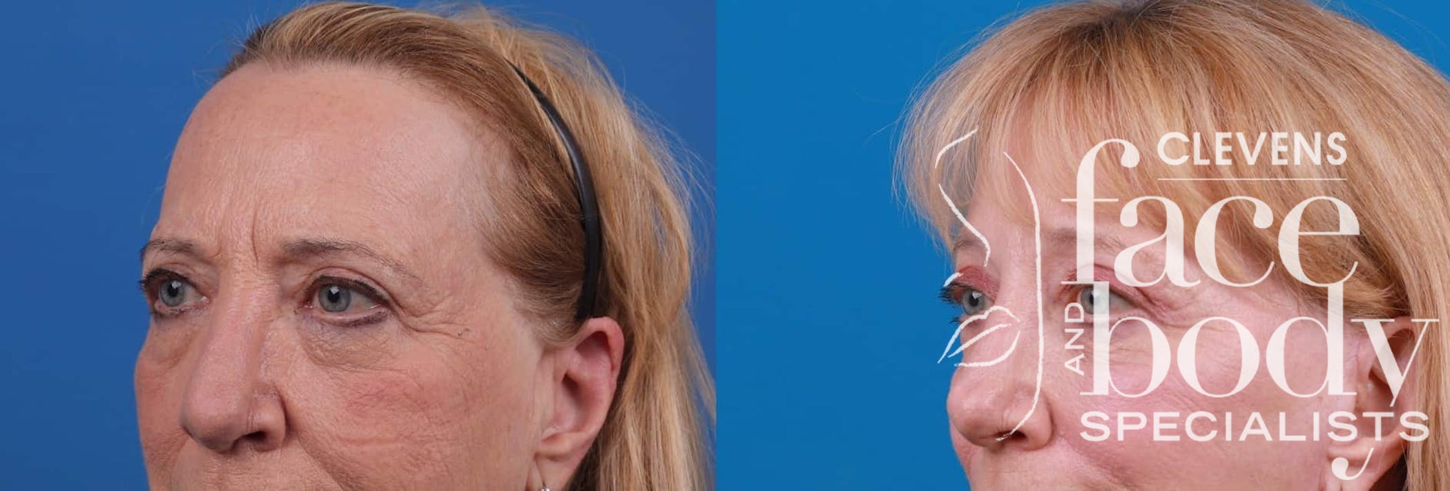 Eyelid Surgery