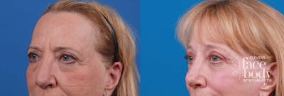 Eyelid Surgery Before & After Gallery - Patient 171801 - Image 1