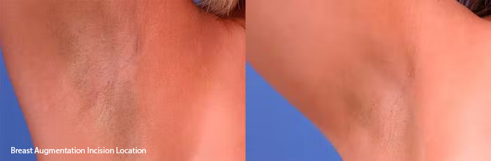 Hidden Breast Aug Before & After Gallery - Patient 211318 - Image 4