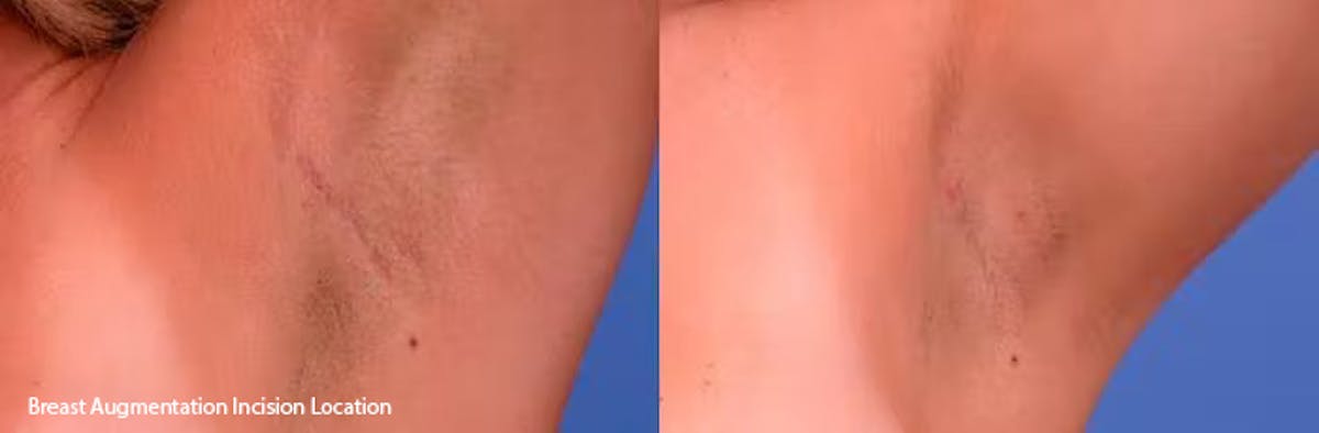 Breast Augmentation Before & After Gallery - Patient 417491 - Image 5
