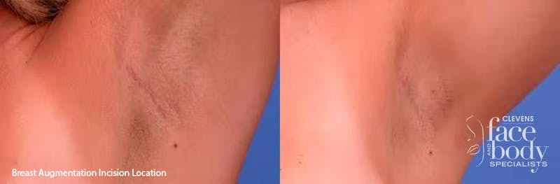 Hidden Breast Aug Before & After Gallery - Patient 125414 - Image 5