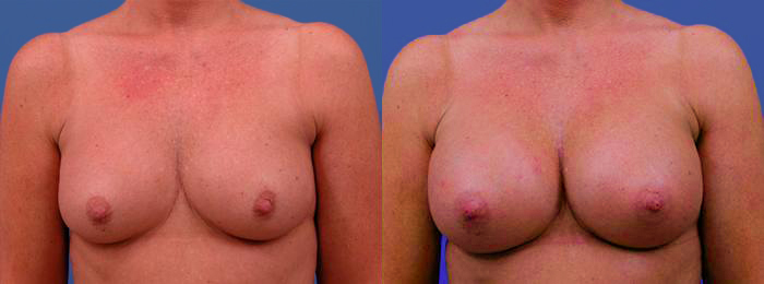 Hidden Breast Aug Before & After Gallery - Patient 690425 - Image 1