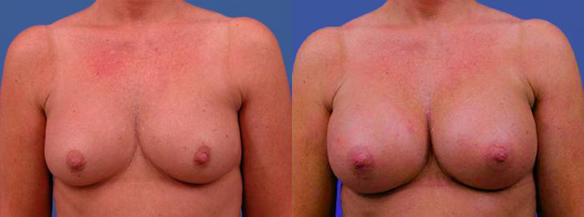 Breast Augmentation Before & After Gallery - Patient 122405421 - Image 1