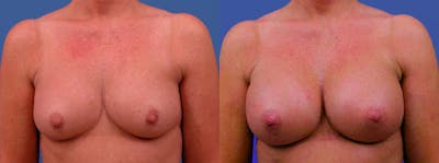 Breast Augmentation Before & After Gallery - Patient 232929 - Image 1