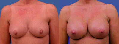 Breast Augmentation Before & After Gallery - Patient 122405421 - Image 1