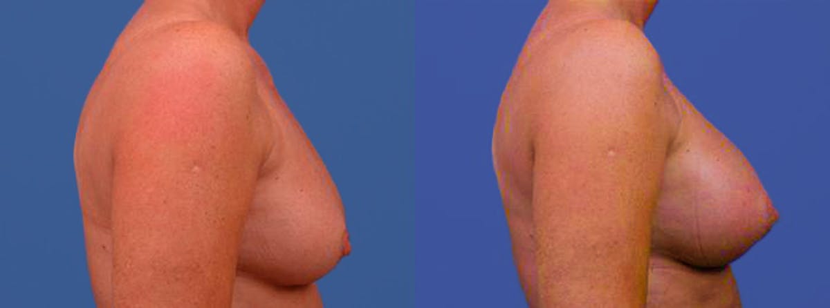 Breast Augmentation Before & After Gallery - Patient 122405421 - Image 2