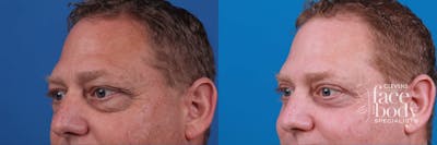 Eyelid Surgery Before & After Gallery - Patient 109294 - Image 1