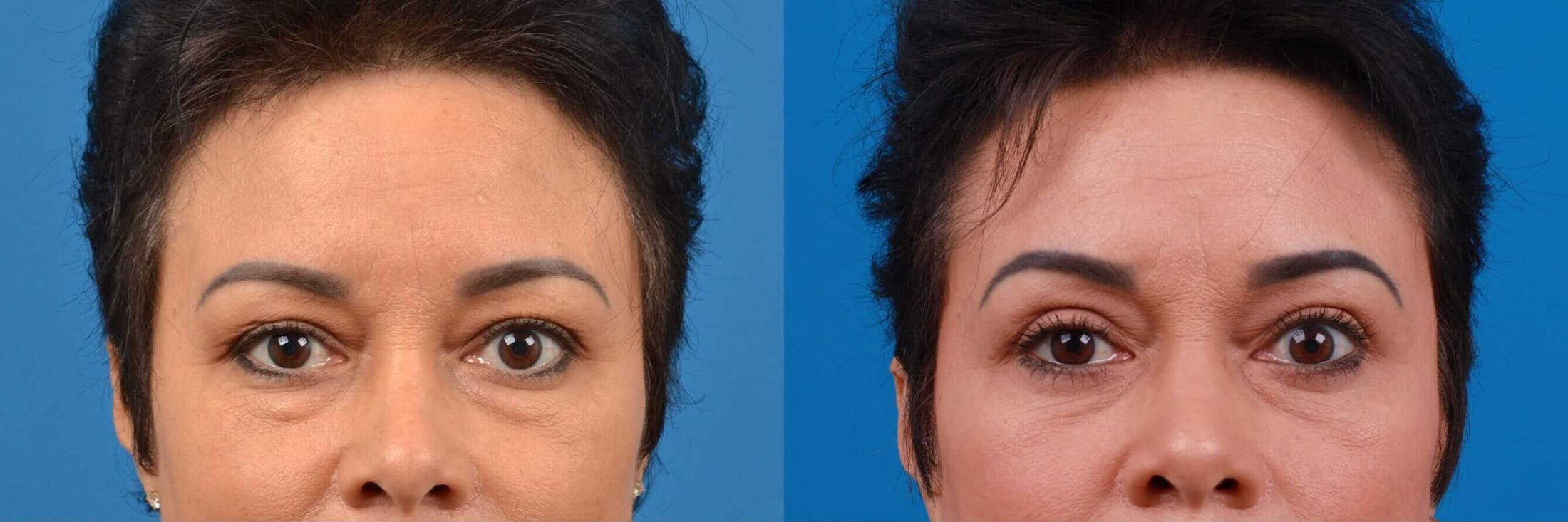 Eyelid Surgery Before & After Gallery - Patient 122444856 - Image 1