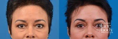 Eyelid Surgery Before & After Gallery - Patient 540403 - Image 1