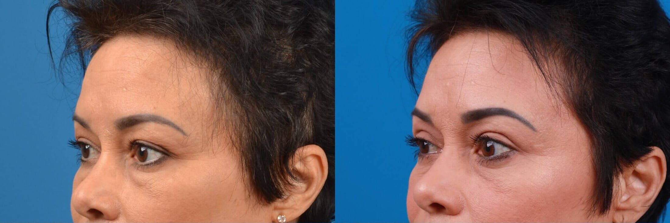 Eyelid Surgery Before & After Gallery - Patient 122444856 - Image 2