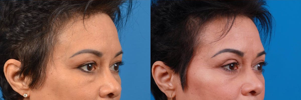 Eyelid Surgery Before & After Gallery - Patient 122444856 - Image 3