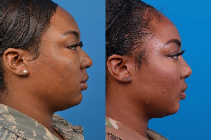 Rhinoplasty Before & After Gallery - Patient 122406958 - Image 4