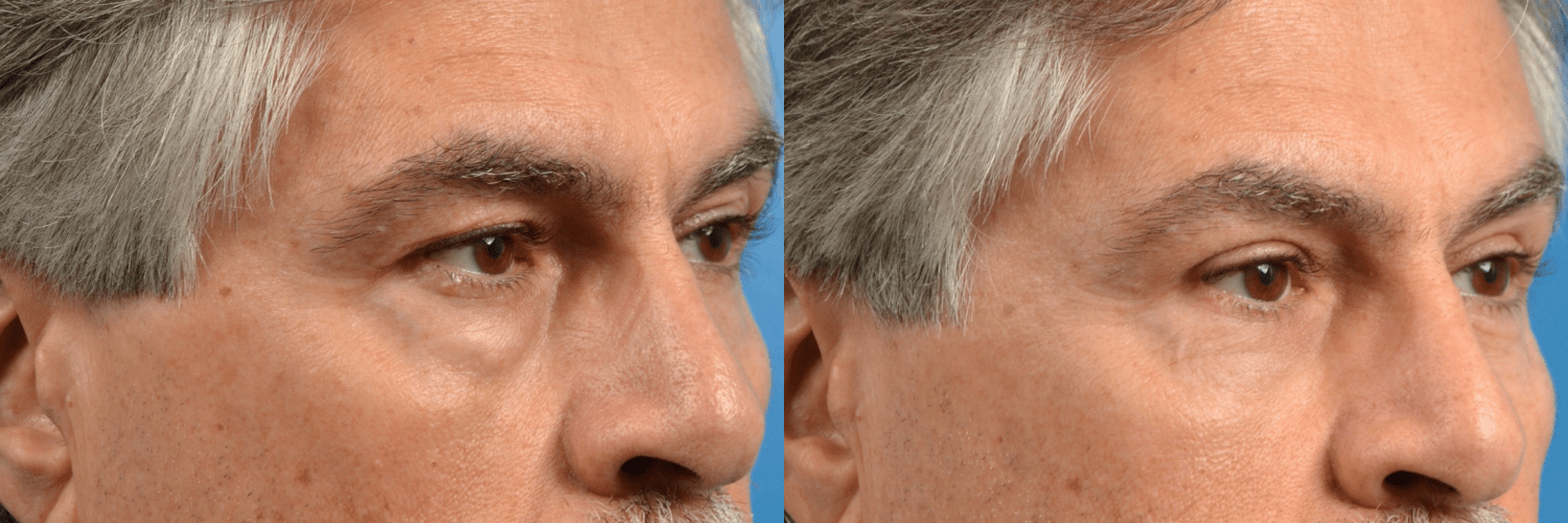 Eyelid Surgery Before & After Gallery - Patient 182943 - Image 1