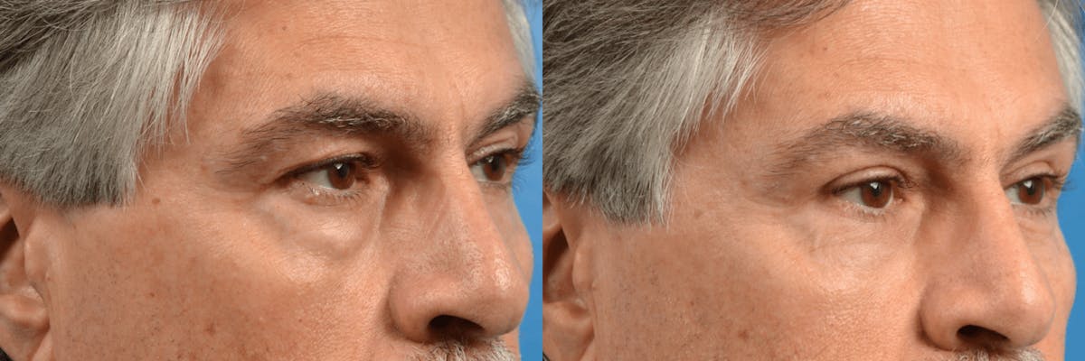 Eyelid Surgery Before & After Gallery - Patient 123022962 - Image 1