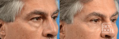 Eyelid Surgery Before & After Gallery - Patient 182943 - Image 1