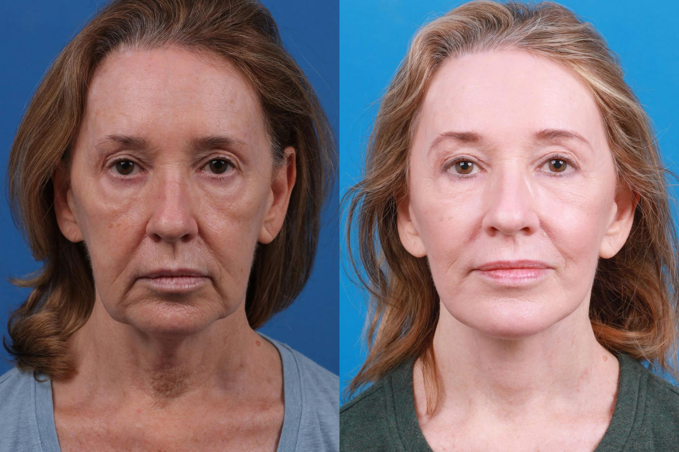 Facelift Before & After Gallery - Patient 146528293 - Image 1