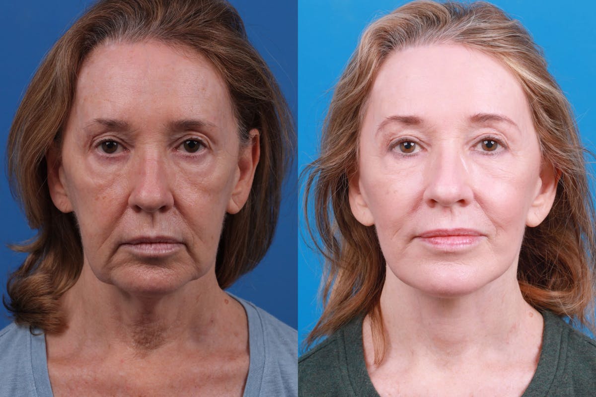 Facelift Before & After Gallery - Patient 146528293 - Image 1