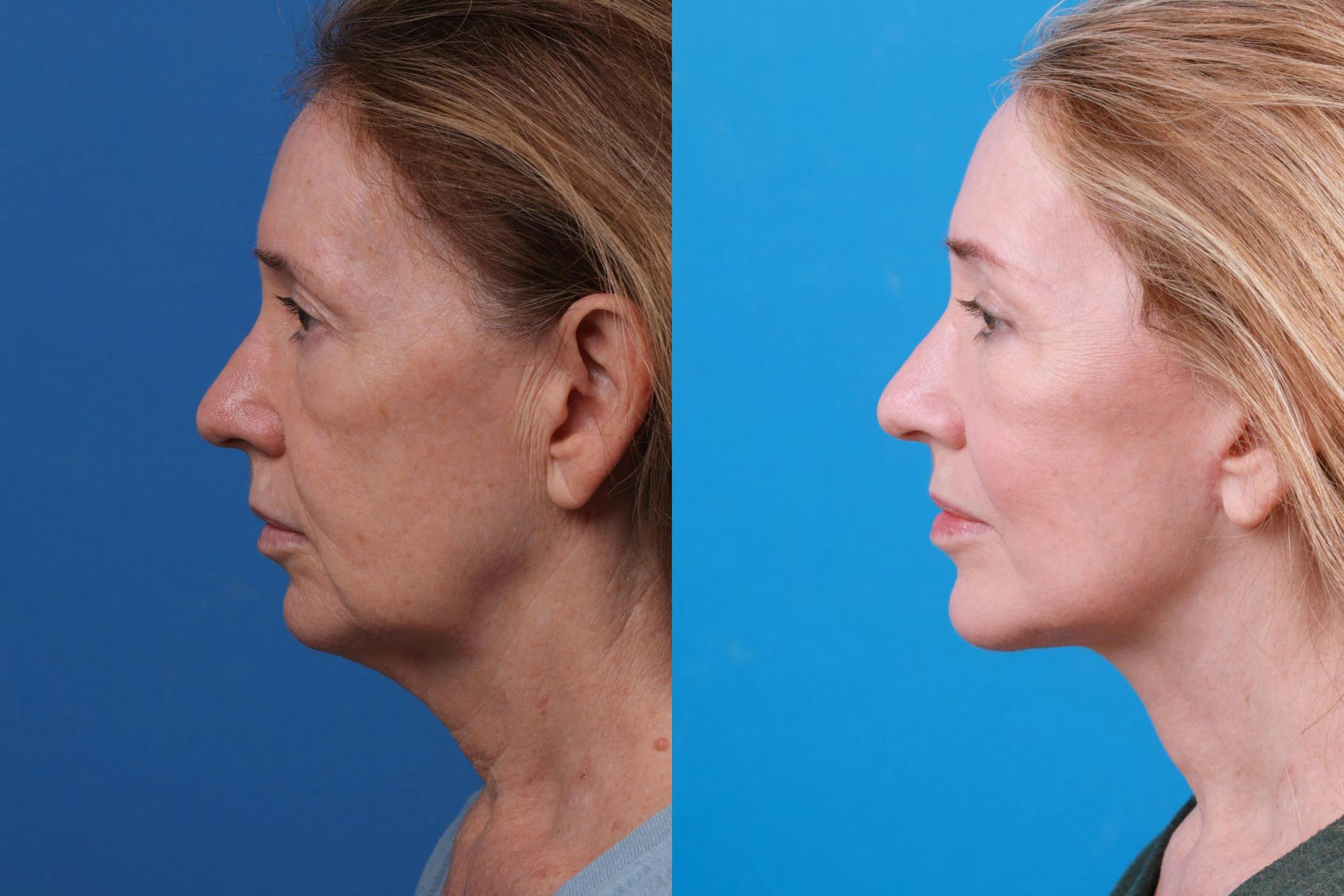Facelift Before & After Gallery - Patient 146528293 - Image 5