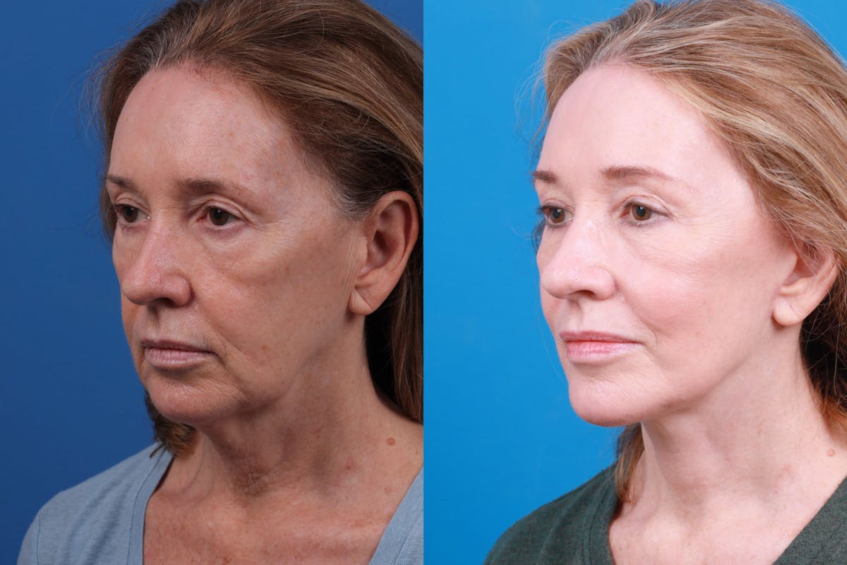 Facelift Before & After Gallery - Patient 146528293 - Image 4
