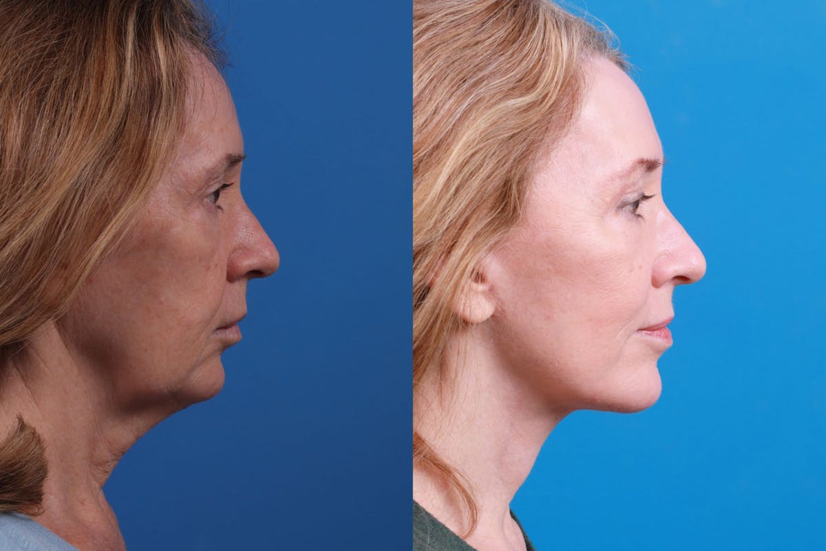 Facelift Before & After Gallery - Patient 146528293 - Image 3