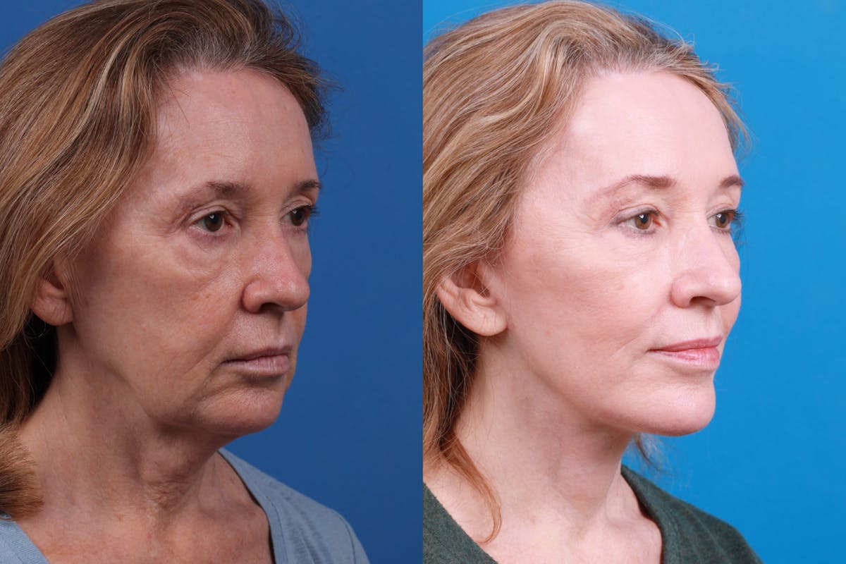 Facelift Before & After Gallery - Patient 146528293 - Image 2