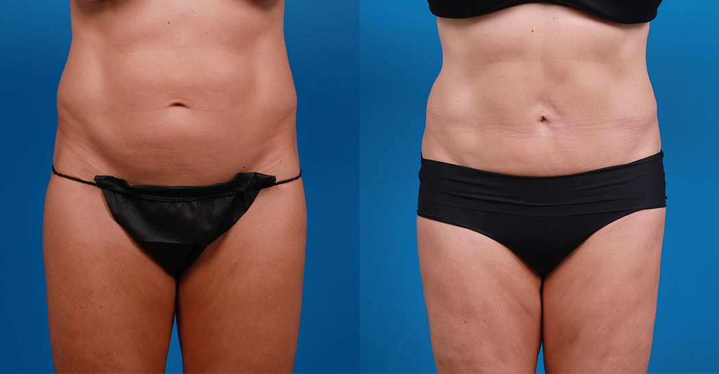 Hidden Liposuction  Before & After Gallery - Patient 232787 - Image 1