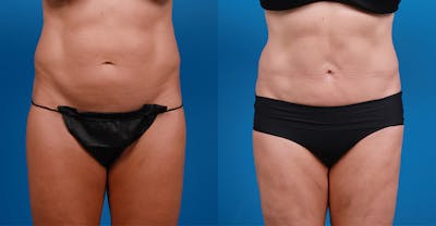 Liponique Body Contouring Before & After Gallery - Patient 146528358 - Image 1