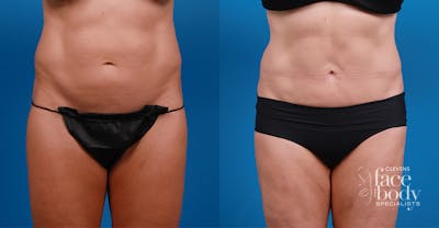 Hidden Liposuction  Before & After Gallery - Patient 232787 - Image 1