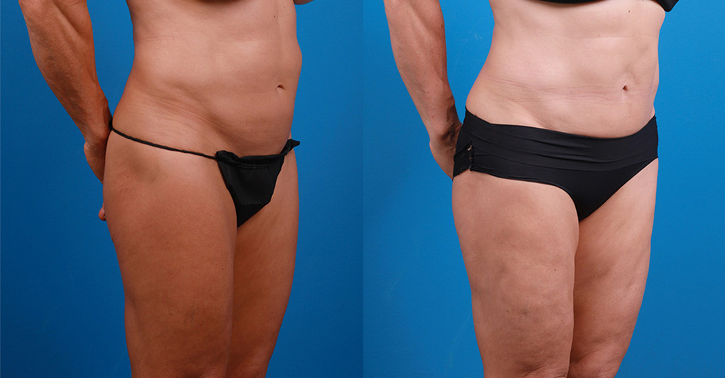 Hidden Liposuction  Before & After Gallery - Patient 232787 - Image 2