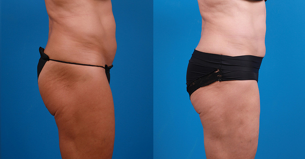 Hidden Liposuction  Before & After Gallery - Patient 232787 - Image 3