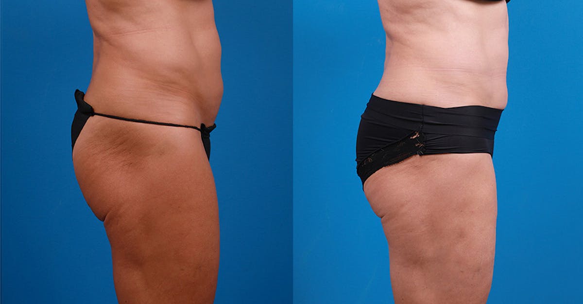 Liposuction Before & After Gallery - Patient 303342 - Image 3