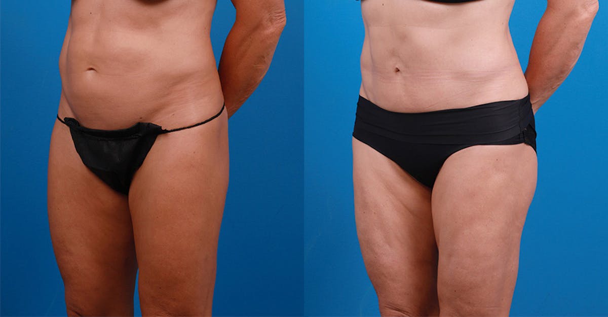 Liposuction Before & After Gallery - Patient 303342 - Image 4