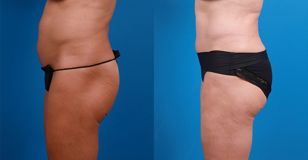 Hidden Liposuction  Before & After Gallery - Patient 232787 - Image 5