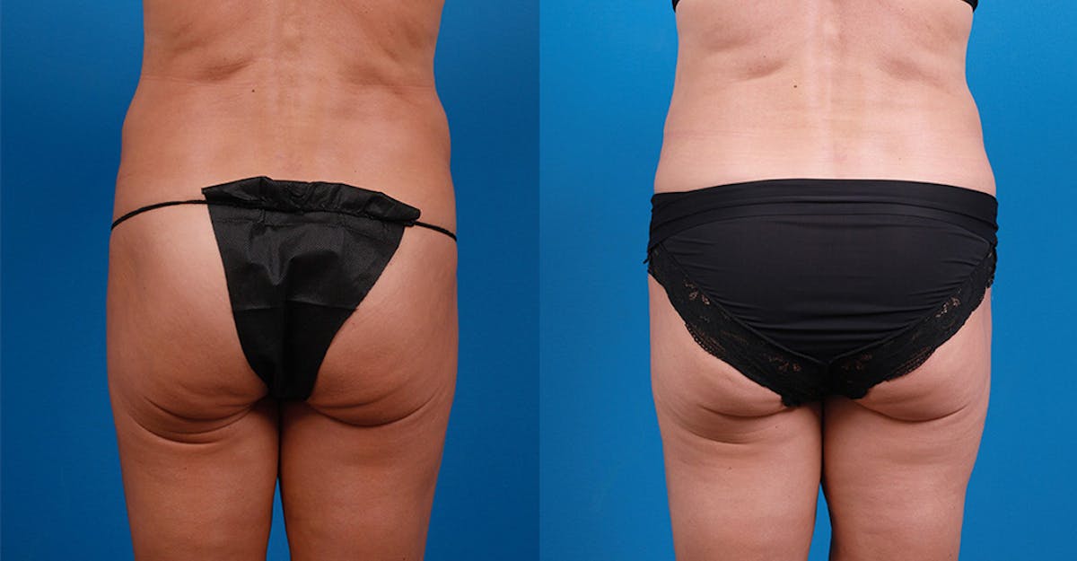 Liposuction Before & After Gallery - Patient 303342 - Image 6