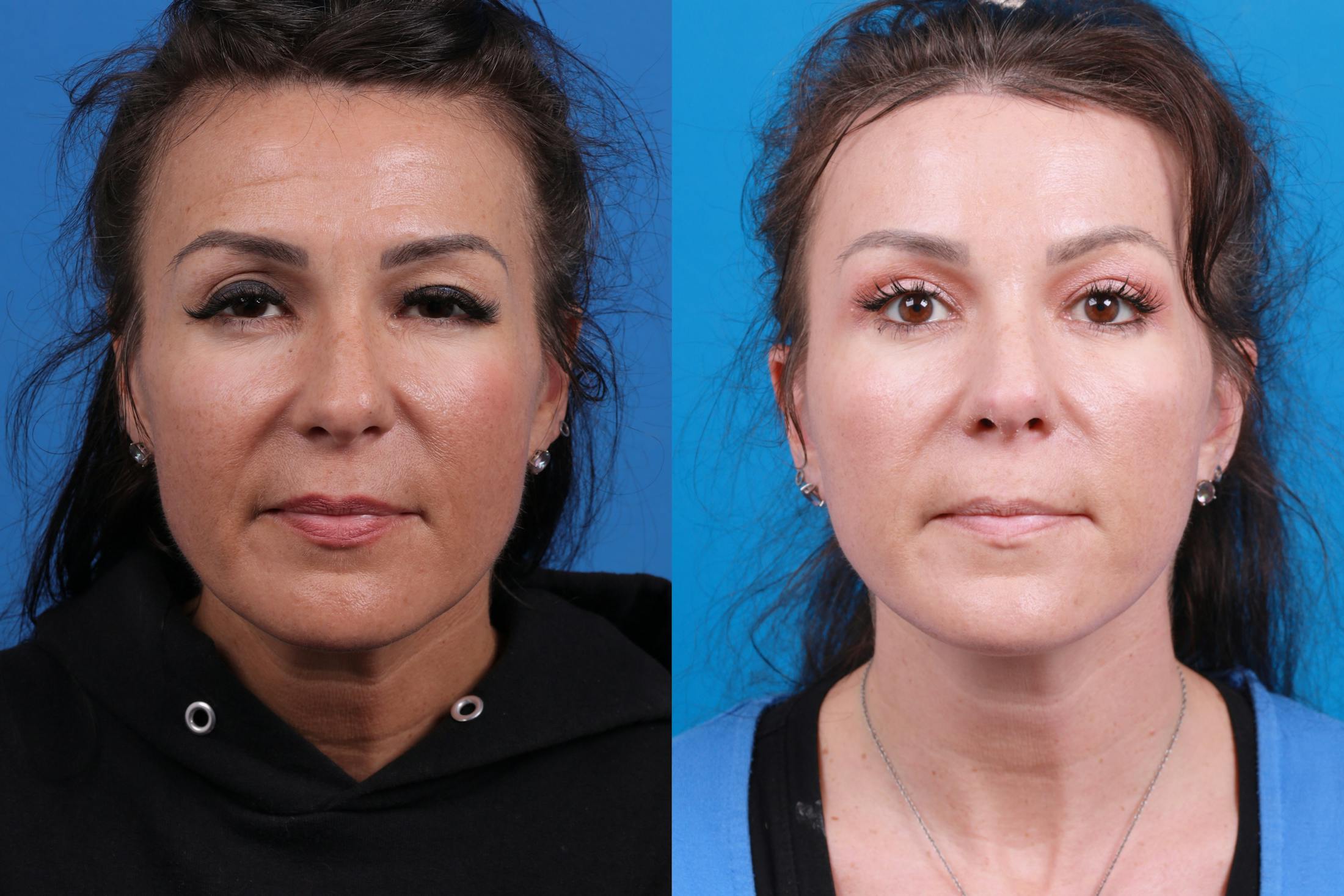 Facelift Before & After Gallery - Patient 146900095 - Image 1
