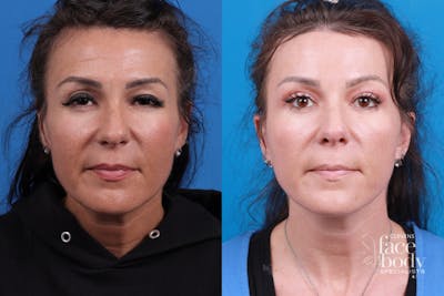Eyelid Surgery Before & After Gallery - Patient 159212 - Image 1