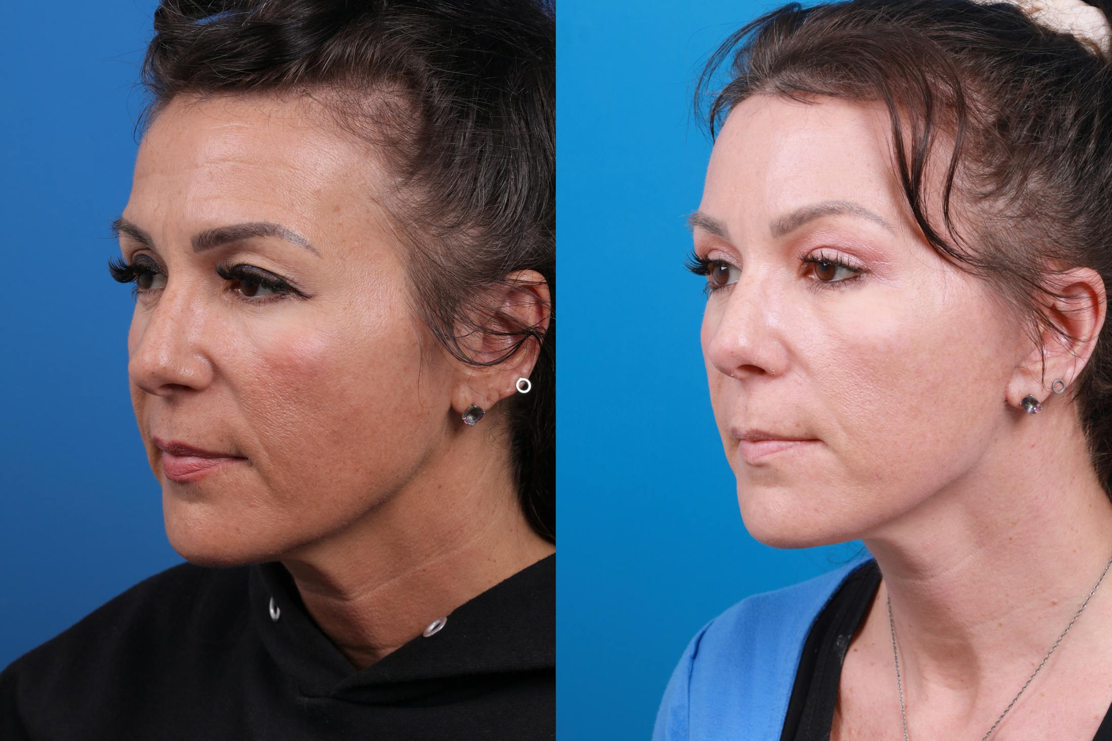 Eyelid Surgery Before & After Gallery - Patient 146900097 - Image 2
