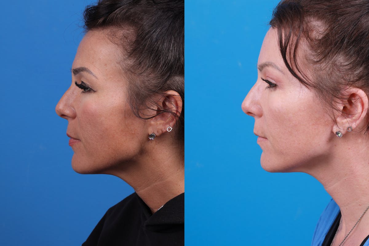 Eyelid Surgery Before & After Gallery - Patient 146900097 - Image 3